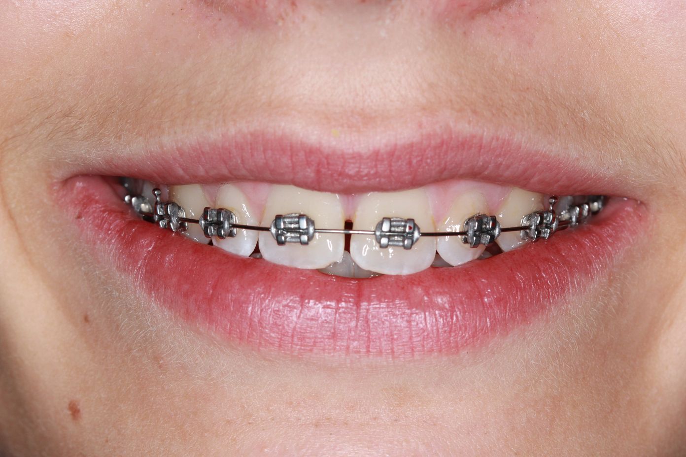 Metal Braces - Traditional Braces Cost - Kingston Orthodontics