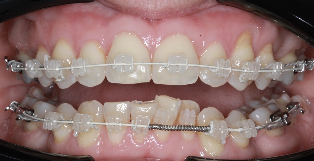 Why Do Teeth Relapse After Wearing Braces?