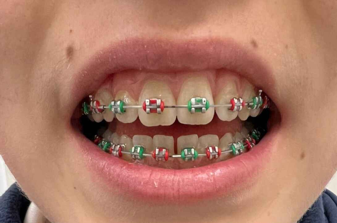 Colors for Braces Bands - Kingston Orthodontics